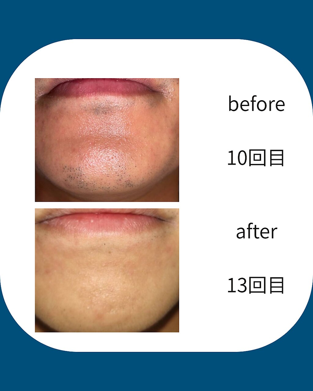 施術イメージ：ヒゲ脱毛のbefore/after・カミソリ負けからの卒業